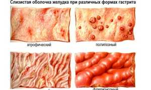 Хронический субатрофический гастрит: что это такое, симптомы, лечение