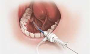 Бужирование протоков слюнных желез