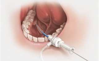 Бужирование протоков слюнных желез