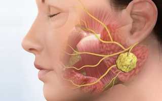 Аденома слюнной железы: причины патологии и способы лечения