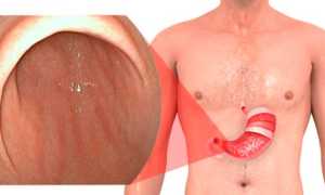 Поверхностный гастрит: что это такое, чем лечить?