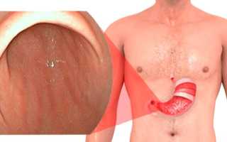 Поверхностный гастрит: что это такое, чем лечить?