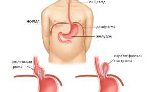 Грыжа пищеводного отверстия диафрагмы: лечение без операции