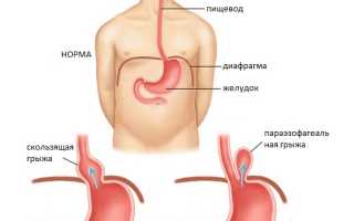 Грыжа пищеводного отверстия диафрагмы: лечение без операции