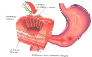 Что такое бульбит желудка, и как лечить