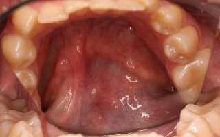 Все о ретенционной кисте слюнной железы