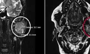 МРТ слюнной железы
