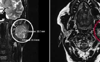 МРТ слюнной железы