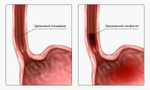 Эрозивный рефлюкс-эзофагит: симптомы и лечение