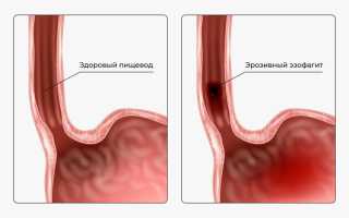 Эрозивный рефлюкс-эзофагит: симптомы и лечение