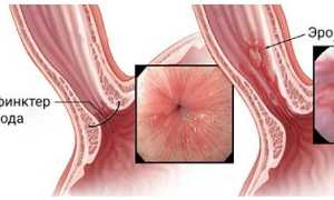 Эрозия пищевода: что это такое и как лечить?