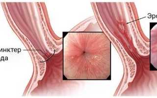 Эрозия пищевода: что это такое и как лечить?