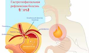 Бродильная диспепсия – что это такое и как лечить