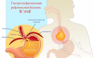 Бродильная диспепсия – что это такое и как лечить