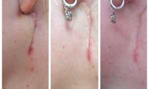 Удаление слюнной железы: жизнь после операции и восстановительный период