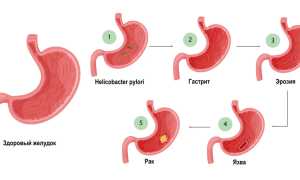 Эрозия желудка: симптомы и лечение, фото