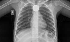 Инородное тело пищевода: симптомы, диагностика, лечение