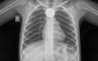 Инородное тело пищевода: симптомы, диагностика, лечение