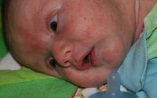 Распознаем и боремся с потницей на лице у грудничка