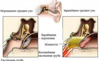 Евстахиит: симптомы и лечение
