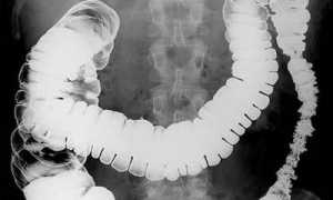 Рентгеноскопия желудка с барием