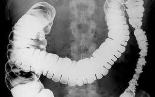 Рентгеноскопия желудка с барием