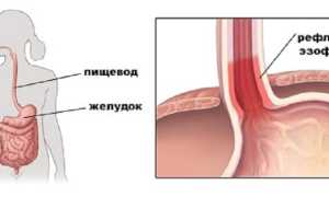 Катаральный рефлюкс-эзофагит – что это такое: симптомы и лечение