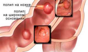 Полипы в кишечнике: причины, симптомы и лечение