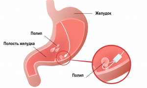 Полип пищевода – от чего появляется, симптомы и лечение