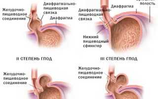 Грыжа пищевода: симптомы и причины развития заболевания, методы лечения