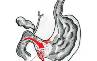 Дуодено-гастральный рефлюкс: причины, симптомы, диагностика, какими препаратами проводится лечение желчного рефлюкса