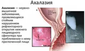 Кардиоспазм пищевода: симптомы и лечение