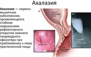 Кардиоспазм пищевода: симптомы и лечение