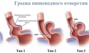 Аксиальная хиатальная грыжа пищевода 1, 2, 3 степени – что это такое: симптомы, лечение и диета