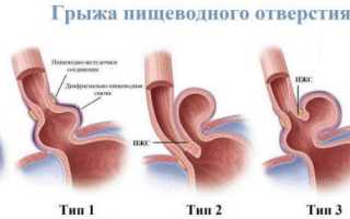 Аксиальная хиатальная грыжа пищевода 1, 2, 3 степени – что это такое: симптомы, лечение и диета