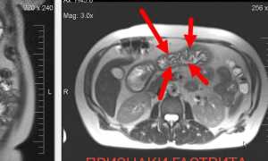 МРТ желудка