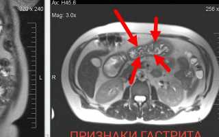 МРТ желудка