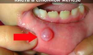 Киста слюнной железы что это такое и как лечить? Лечение кист околоушной, подчелюстной, подъязычной и малой слюнных желез