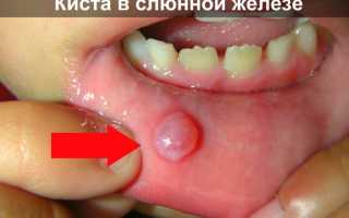 Киста слюнной железы что это такое и как лечить? Лечение кист околоушной, подчелюстной, подъязычной и малой слюнных желез
