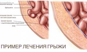 Грыжа пищевода: как делают операцию, и как проходит реабилитационный период после хирургического лечения