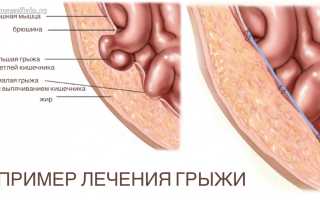 Грыжа пищевода: как делают операцию, и как проходит реабилитационный период после хирургического лечения