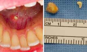 Слюннокаменная болезнь: лечение сиалолитиаза у детей и взрослых