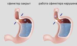 Что такое рефлюкс-эзофагит у взрослых: причины, симптомы, лечение