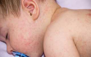 Что такое токсическая эритема у новорожденного? Насколько безопасно данное состояние? Что стоит предпринять родителям?