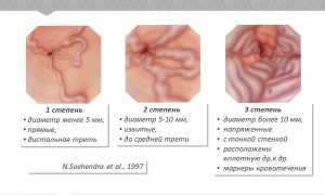 Кровотечение из расширенных вен пищевода