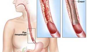 Стентирование пищевода при раке и травме
