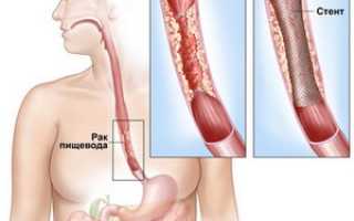 Стентирование пищевода при раке и травме