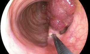 Операция удаление полипа желудка эндоскопическим методом, лечение после операции