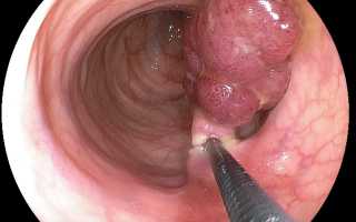 Операция удаление полипа желудка эндоскопическим методом, лечение после операции