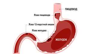 Язва пищевода: симптомы и лечение. Чем лечить язву пищевода: лекарственные препараты и народные средства